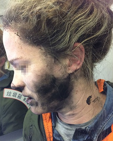 Airline passenger burned when headphone battery explodes mid-flight